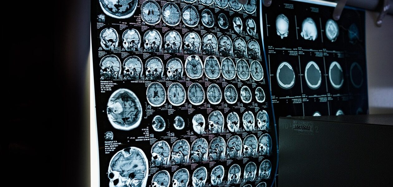 Два роки невідомої хвороби: у жінки діагностували пухлину мозку