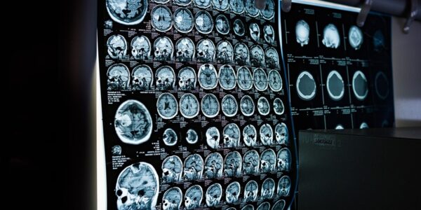 Два роки невідомої хвороби: у жінки діагностували пухлину мозку